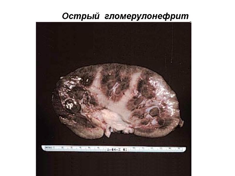 Острый  гломерулонефрит